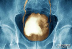 膀胱癌也有分期,哪一期才适合做手术呢?
